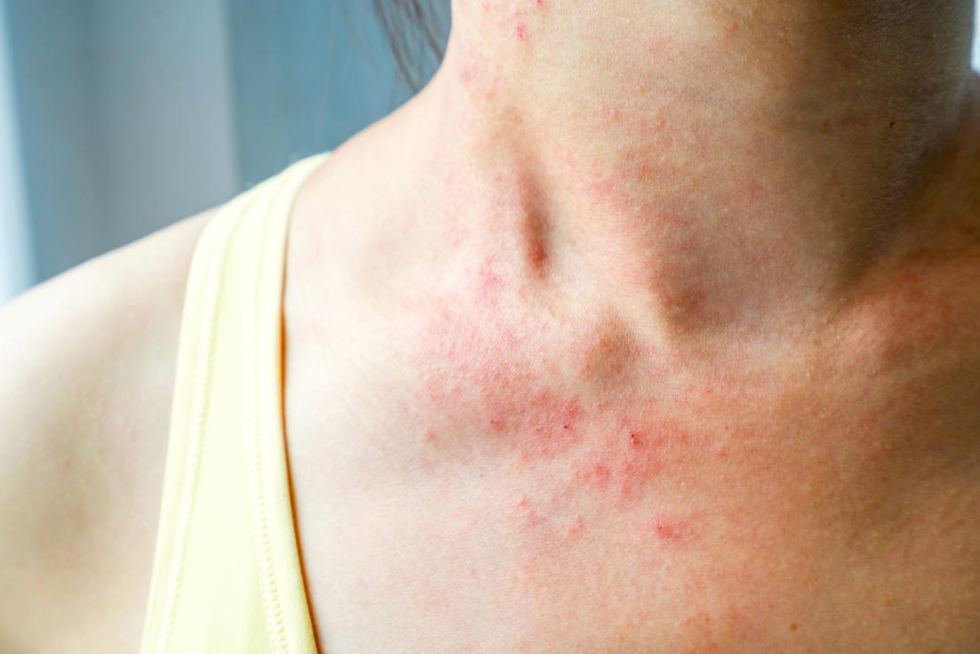 Allergie au chlore : symptômes et préventions