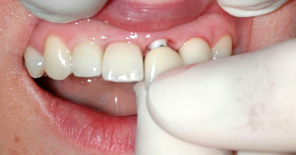 Implant dentaire et remboursement, comment ça marche ?